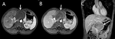 Benign Pancreatic Neurofibroma with Malignant Imaging Features: A Case Report and Literature Review